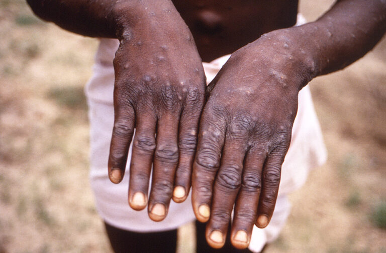 Nigeria confirms 21 monkeypox cases