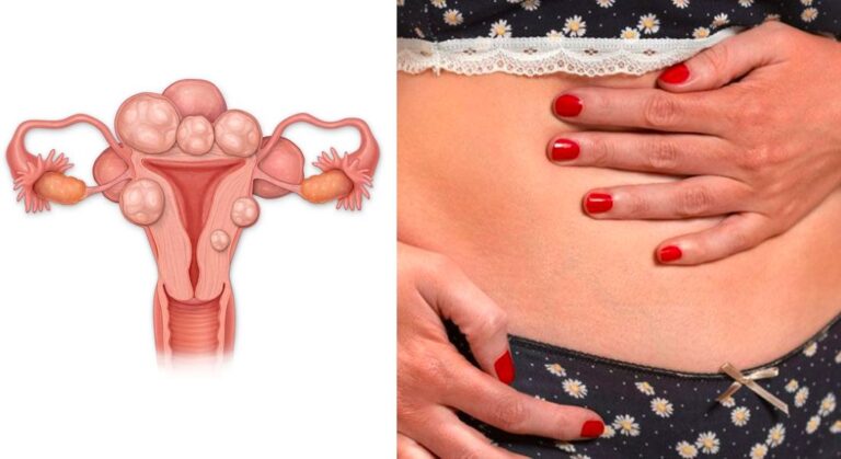 How To Prevent Death From Fibroids – Expert