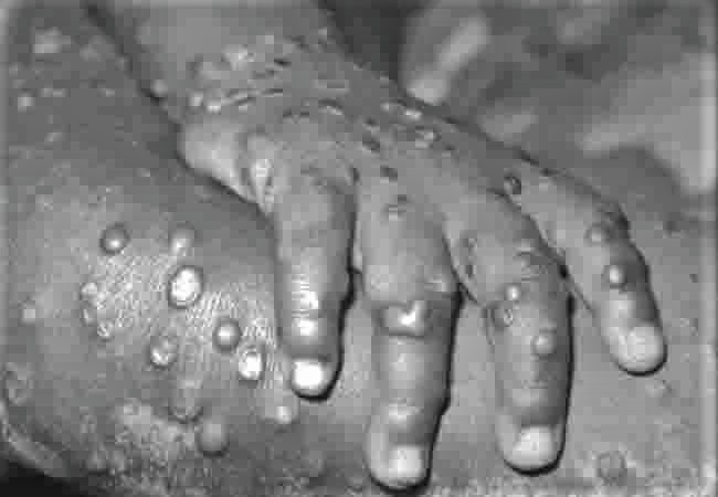 Persons with weak immune systems could be more at risk of monkeypox —Virologist