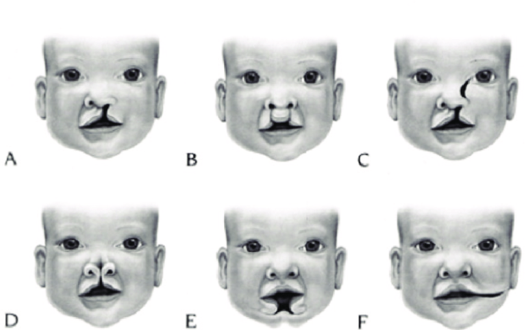 What You Should Know About Orofacial Cleft