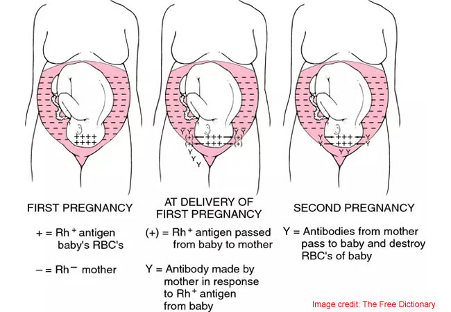 What Rhesus negative women need to know before pregnancy –Gynaecologist