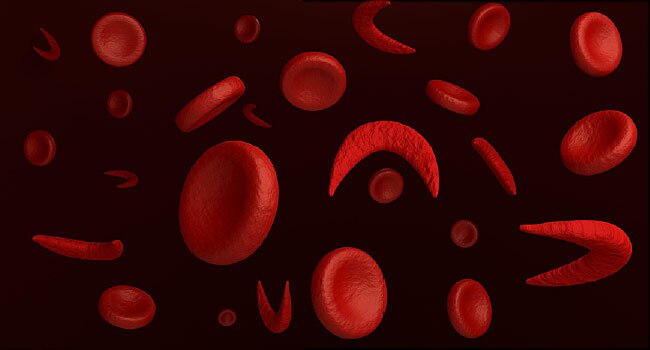 Sickle cell and insecurity – Healthwise