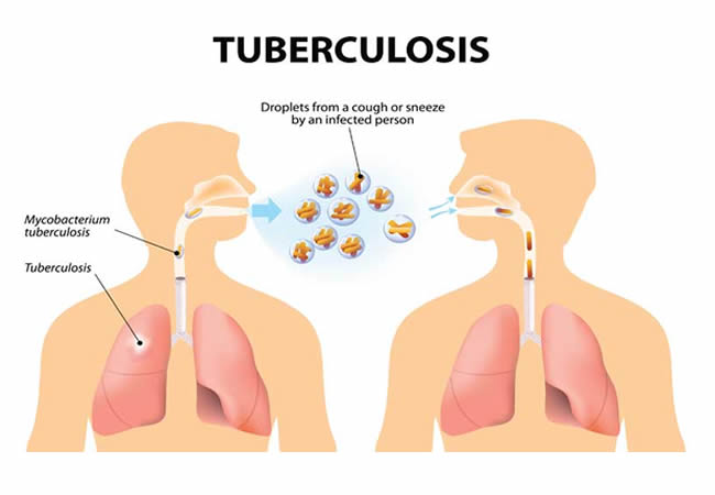 WHO launches new operational handbook on TB care, support