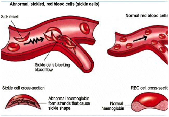 Sickle cell and mental health