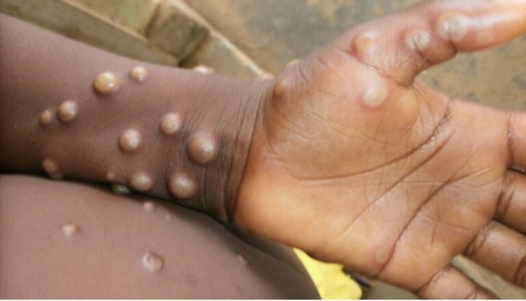 Katsina records first monkeypox case, awaiting 15 results, says commissioner
