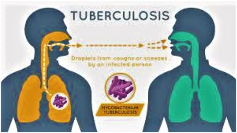 Tuberculosis kills 4,100 people daily, says Africa CDC