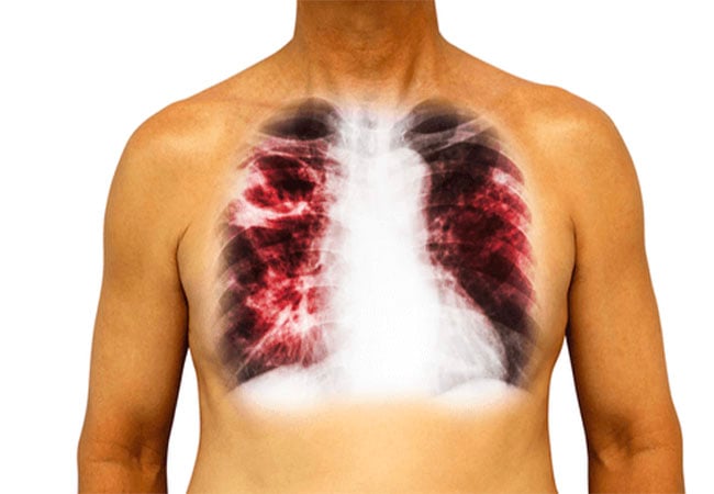Anambra detects 8,000 tuberculosis cases in 2022 